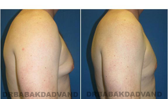 Gynecomastia. Before and After Treatment Photos - male, right side view (patient 1)