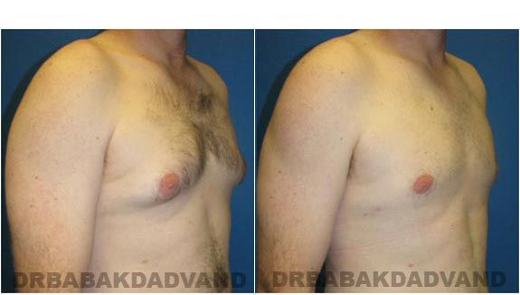 Gynecomastia. Before and After Treatment Photos - male, right side oblique view (patient 1)