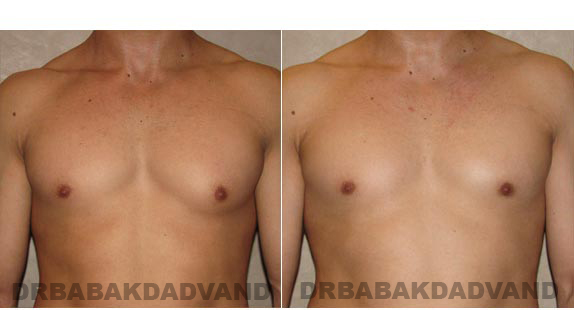 Gynecomastia. Before and After Treatment Photos - male - front view (patient - 7)