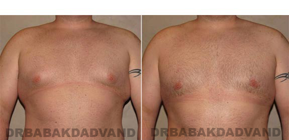 Gynecomastia. Before and After Treatment Photos - male, front view (patient 10)