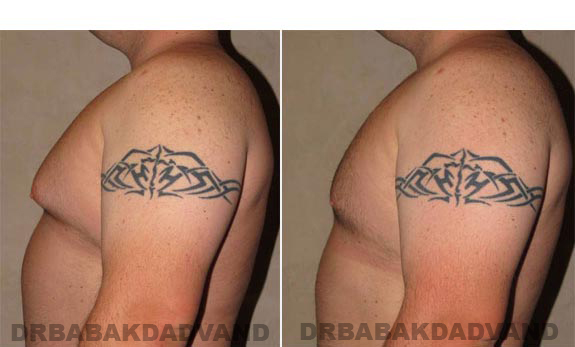 Gynecomastia. Before and After Treatment Photos - male, left side view (patient 10)