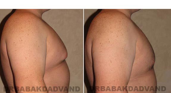 Gynecomastia. Before and After Treatment Photos - male, right side view (patient 10)
