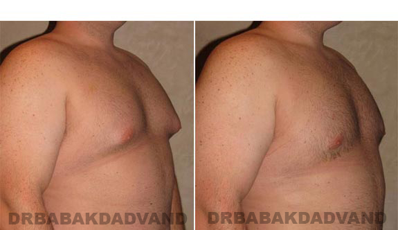 Gynecomastia. Before and After Treatment Photos - male, right side oblique view (patient 10)