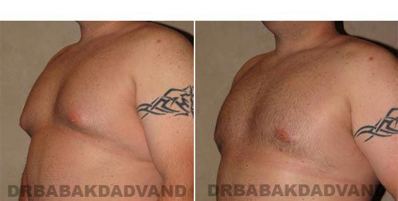 Gynecomastia. Before and After Treatment Photos - male, left side oblique view (patient 10)