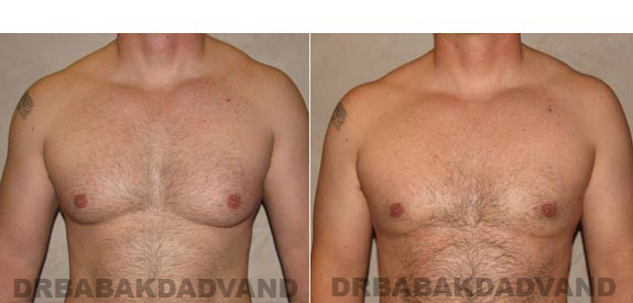 Gynecomastia. Before and After Treatment Photos - male, front view (patient 11)