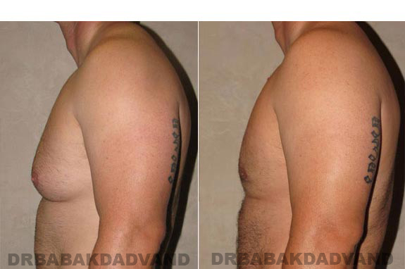 Gynecomastia. Before and After Treatment Photos - male, left side view (patient 11)