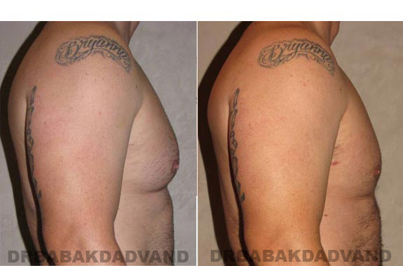 Gynecomastia. Before and After Treatment Photos - male, right side view (patient 11)