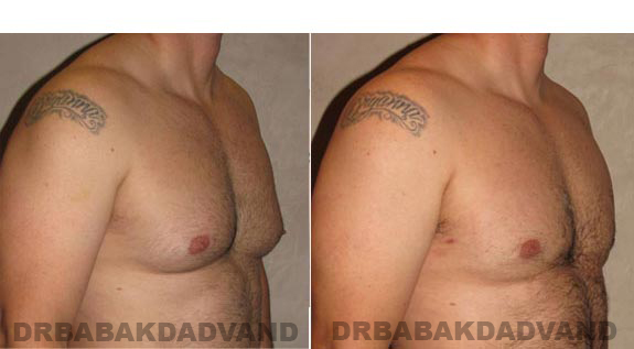 Gynecomastia. Before and After Treatment Photos - male, right side oblique view (patient 11)