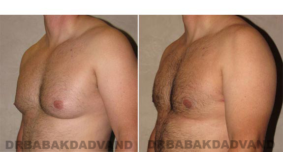 Gynecomastia. Before and After Treatment Photos - male, left side oblique view (patient 11)