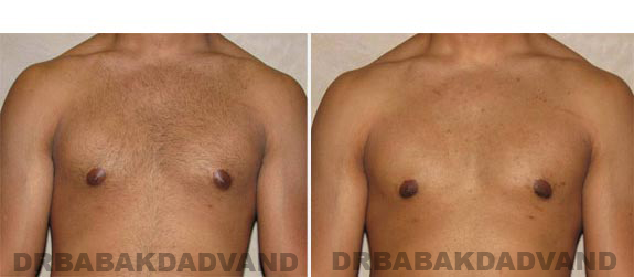 Gynecomastia. Before and After Treatment Photos - male, front view (patient 12)