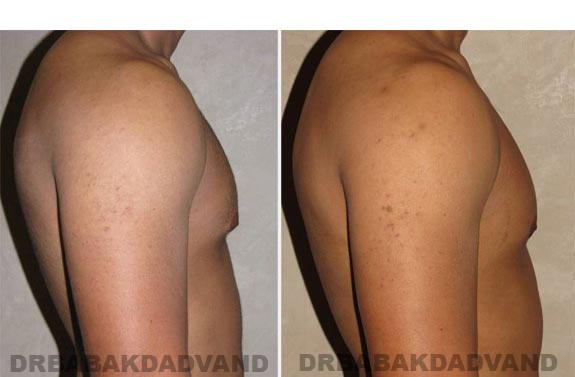 Gynecomastia. Before and After Treatment Photos - male, right side view (patient 12)