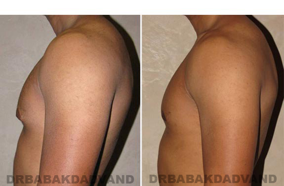 Gynecomastia. Before and After Treatment Photos - male, left side view (patient 12)
