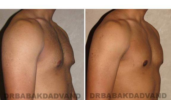 Gynecomastia. Before and After Treatment Photos - male, right side oblique view (patient 12)