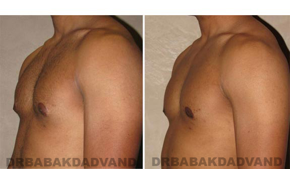 Gynecomastia. Before and After Treatment Photos - male, left side oblique view (patient 12)