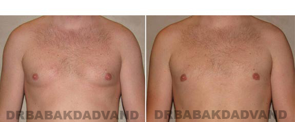 Gynecomastia. Before and After Treatment Photos - male, front view (patient 14)