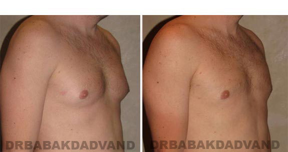 Gynecomastia. Before and After Treatment Photos - male, right side oblique view (patient 14)