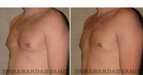 Gynecomastia. Before and After Treatment Photos - male, left side oblique view (patient 14)
