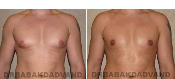Gynecomastia. Before and After Treatment Photos - male - front view (patient - 8)
