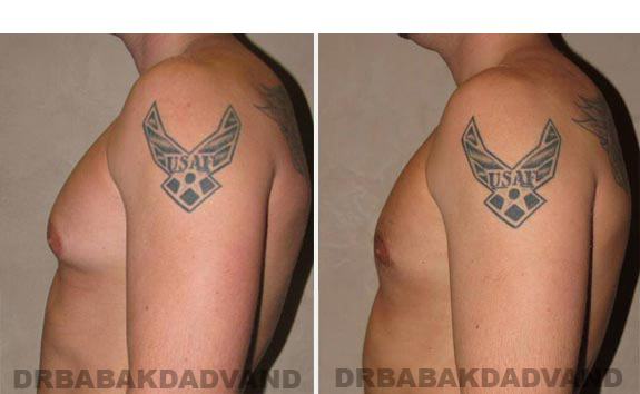Gynecomastia. Before and After Treatment Photos - male - left side view (patient - 8)