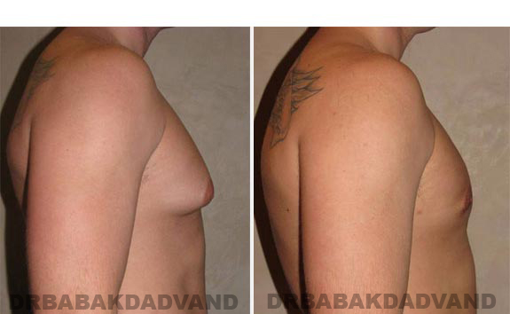 Gynecomastia. Before and After Treatment Photos - male - right side view (patient - 8)