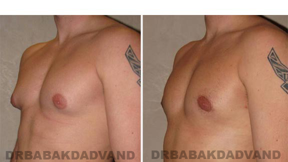Gynecomastia. Before and After Treatment Photos - male - left side oblique view (patient 8)