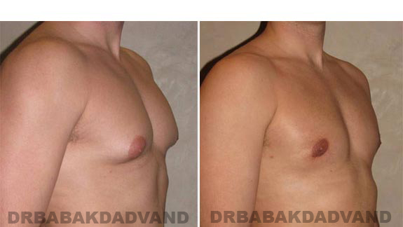 Gynecomastia. Before and After Treatment Photos - male - right side oblique view (patient - 8)