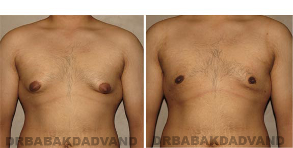 Gynecomastia. Before and After Treatment Photos - male, front view (patient 16)