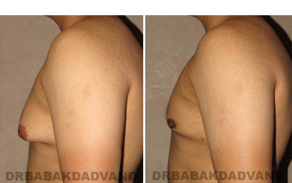 Gynecomastia. Before and After Treatment Photos - male, left side view (patient 16)