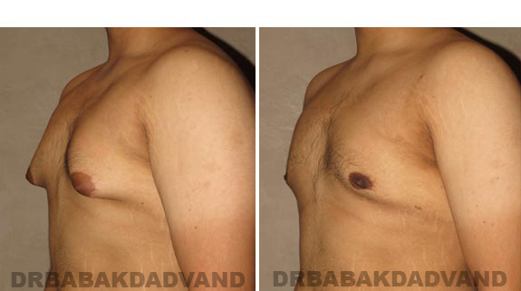 Gynecomastia. Before and After Treatment Photos - male, left side oblique view (patient 16)