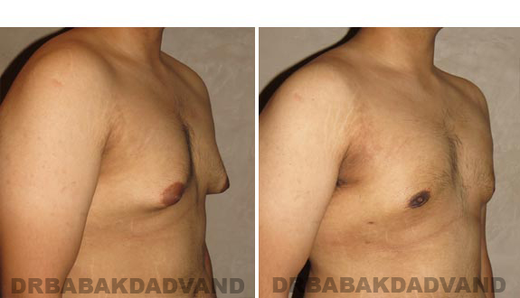 Gynecomastia. Before and After Treatment Photos - male, right side oblique view (patient 16)