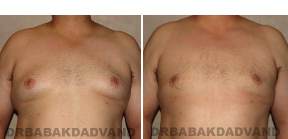 Gynecomastia. Before and After Treatment Photos - male, front view (patient 15)