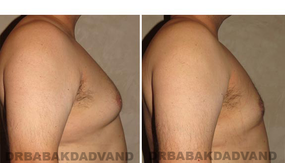 Gynecomastia. Before and After Treatment Photos - male, right side view (patient 15)