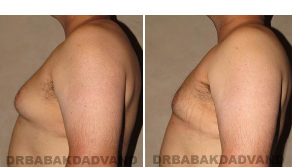 Gynecomastia. Before and After Treatment Photos - male, left side view (patient 15)