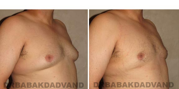 Gynecomastia. Before and After Treatment Photos - male, right side oblique view (patient 15)