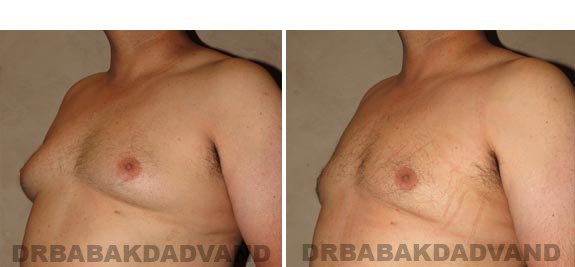 Gynecomastia. Before and After Treatment Photos - male, left side oblique view (patient 15)