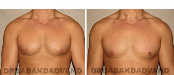Gynecomastia. Before and After Treatment Photos - male, front view (patient 3)