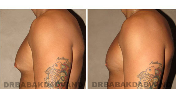 Gynecomastia. Before and After Treatment Photos - male, left side view (patient 3)