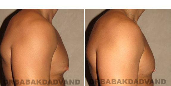 Gynecomastia. Before and After Treatment Photos - male, right side view (patient 3)