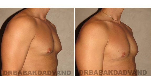Gynecomastia. Before and After Treatment Photos - male, right side oblique view (patient 3)