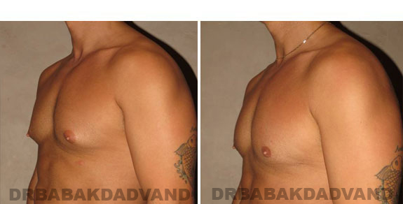 Gynecomastia. Before and After Treatment Photos - male, left side oblique view (patient 3)