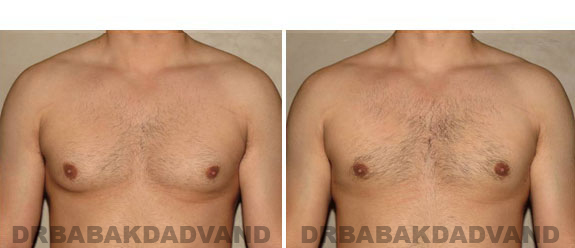 Gynecomastia. Before and After Treatment Photos - male - front view (patient - 5)
