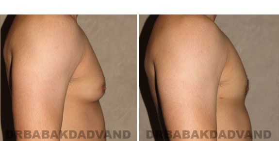 Gynecomastia. Before and After Treatment Photos - male - right side view (patient - 5)