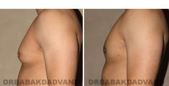 Gynecomastia. Before and After Treatment Photos - male - left side view (patient - 5)