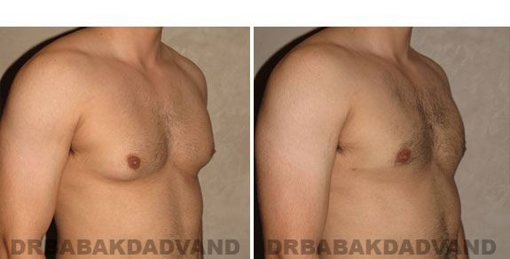 Gynecomastia. Before and After Treatment Photos - male - right side oblique view (patient - 5)