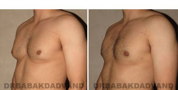 Gynecomastia. Before and After Treatment Photos - male - left side view (patient - 5)