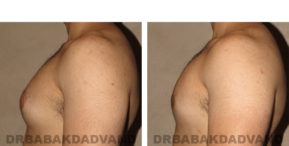 Gynecomastia. Before and After Treatment Photos - male, left side view (patient 19)