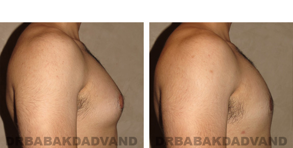 Gynecomastia. Before and After Treatment Photos - male, right side view (patient 19)