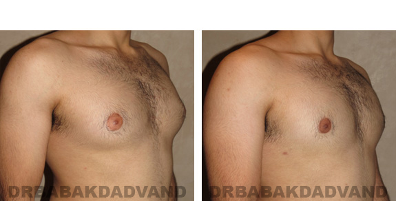 Gynecomastia. Before and After Treatment Photos - male, right side oblique view (patient 19)