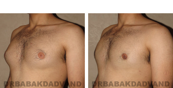 Gynecomastia. Before and After Treatment Photos - male, left side oblique view (patient 19)