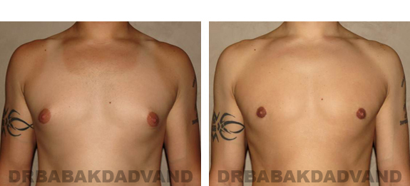 Gynecomastia. Before and After Treatment Photos - male, front view (patient 21)